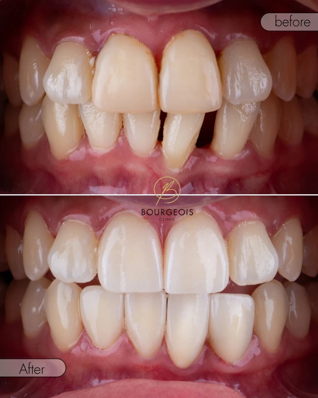 Bourgeois Dental Clinic - Case 2 | Bourgeois Dental Clinic