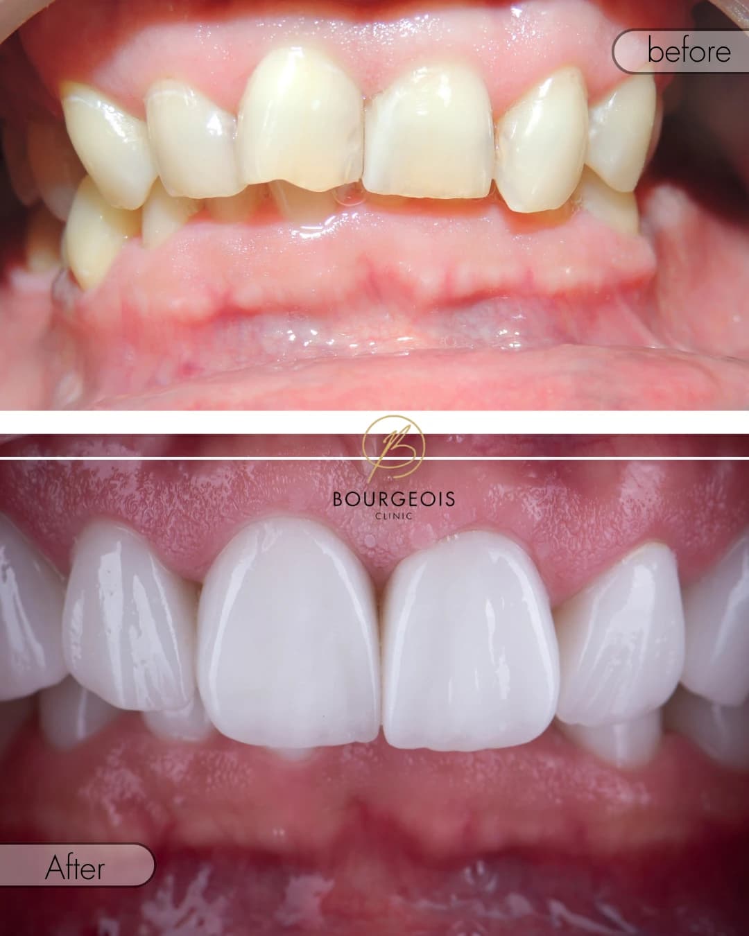 Bourgeois Dental Clinic - Case 1 | Bourgeois Dental Clinic