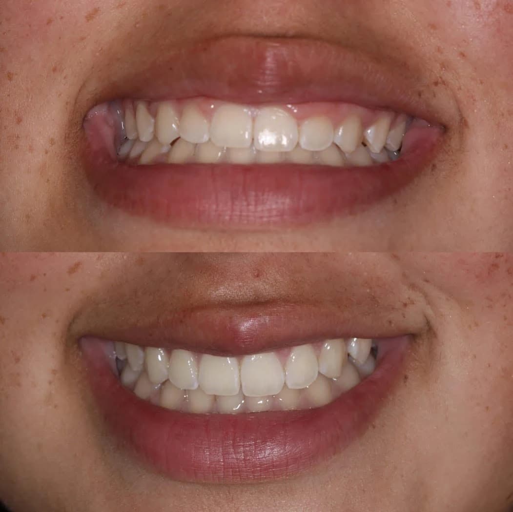 Bourgeois Dental Clinic - Case 5 | Bourgeois Dental Clinic