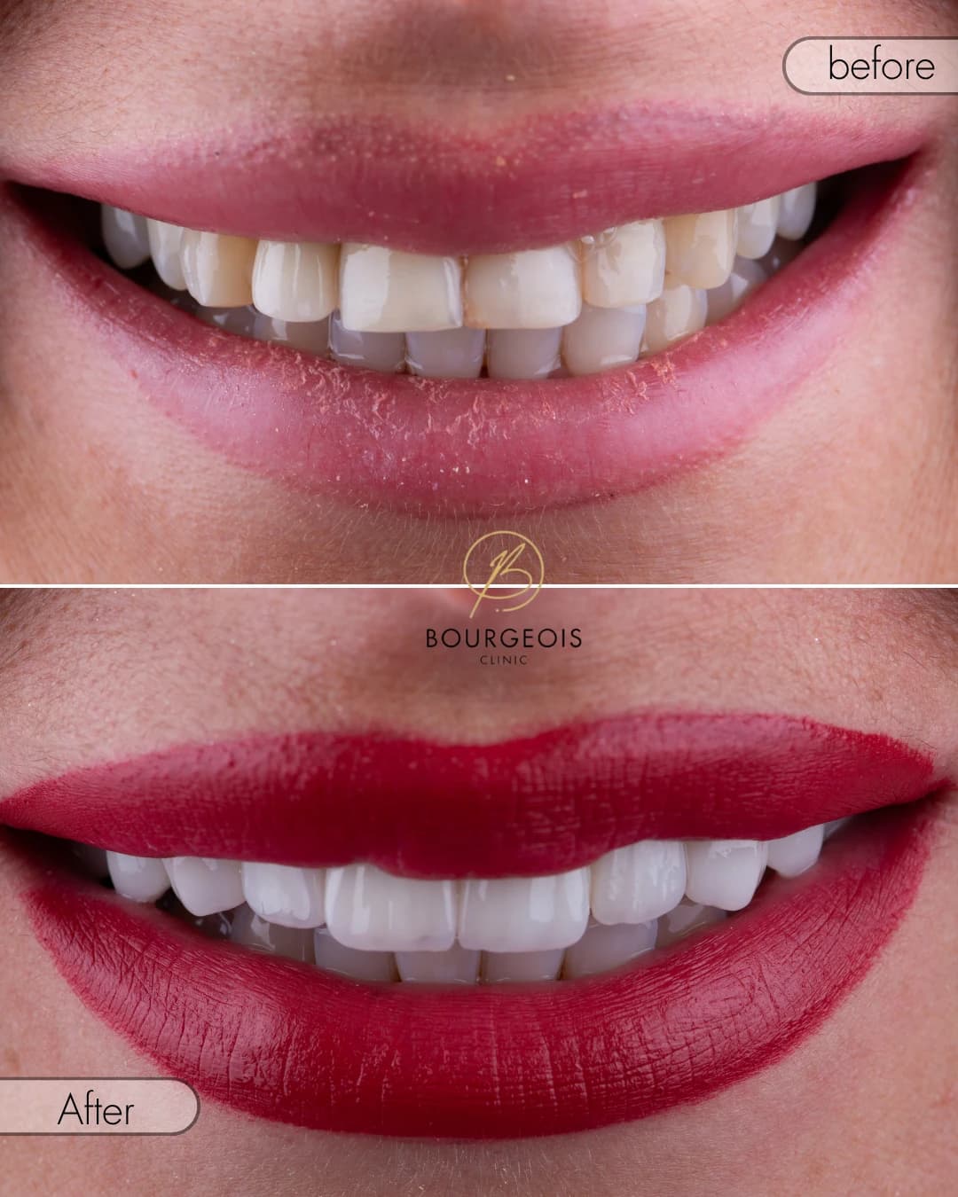 Bourgeois Dental Clinic - Case 10 | Bourgeois Dental Clinic