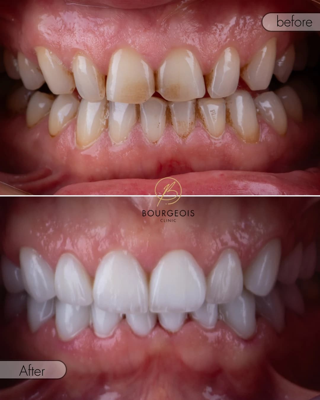 Bourgeois Dental Clinic - Case 2 | Bourgeois Dental Clinic
