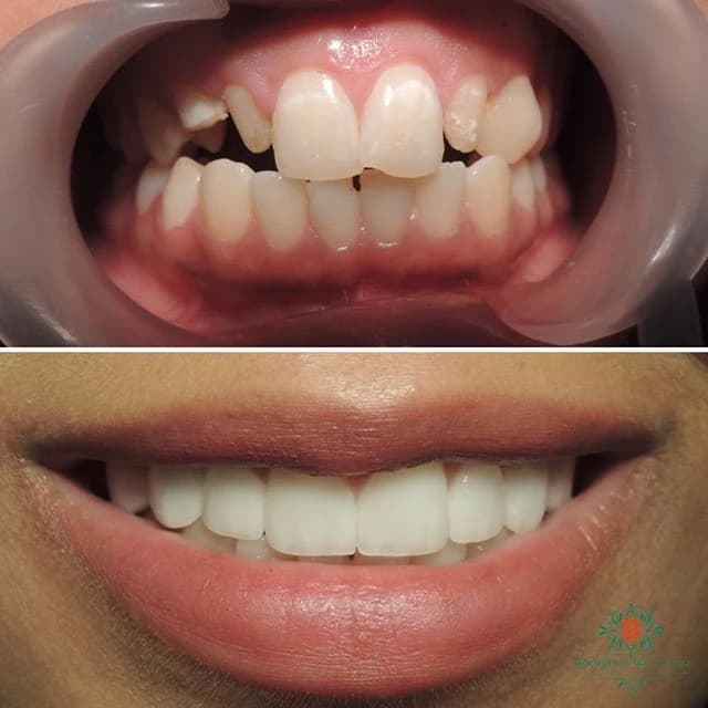 Bourgeois Dental Clinic - Case 6 | Bourgeois Dental Clinic