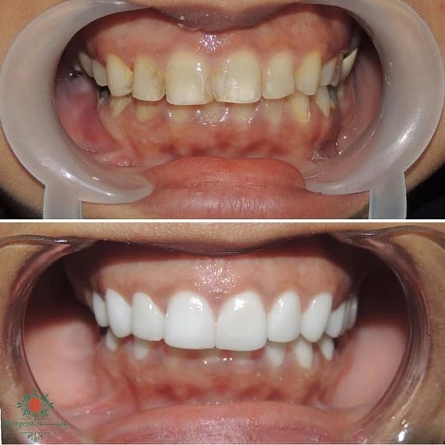 Bourgeois Dental Clinic - Case 9 | Bourgeois Dental Clinic