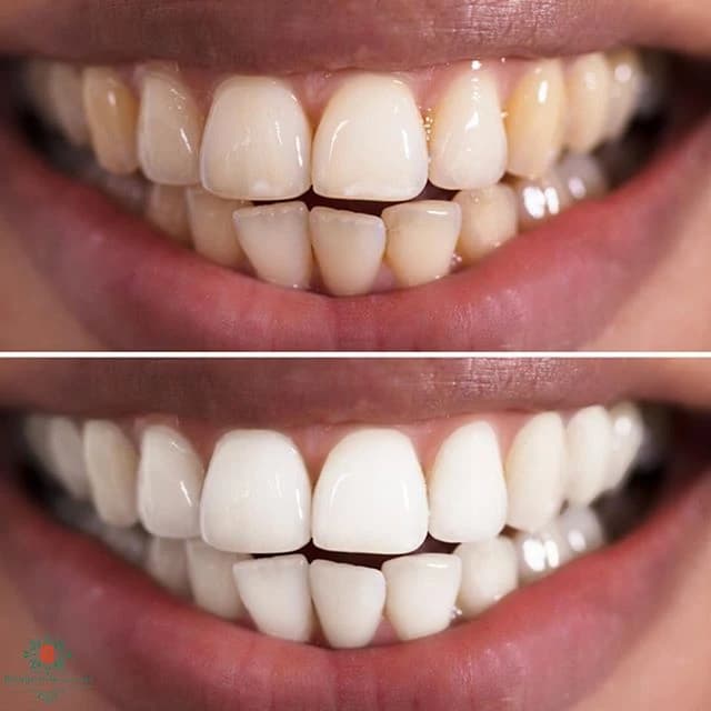 Bourgeois Dental Clinic - Case 10 | Bourgeois Dental Clinic