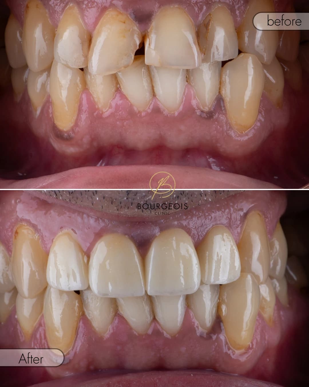 Bourgeois Dental Clinic - Case 6 | Bourgeois Dental Clinic