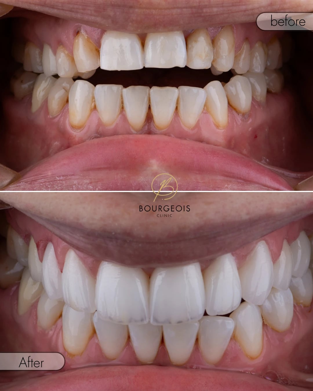 Dental Veneers in Dubai | Bourgeois Dental Clinic Dubai