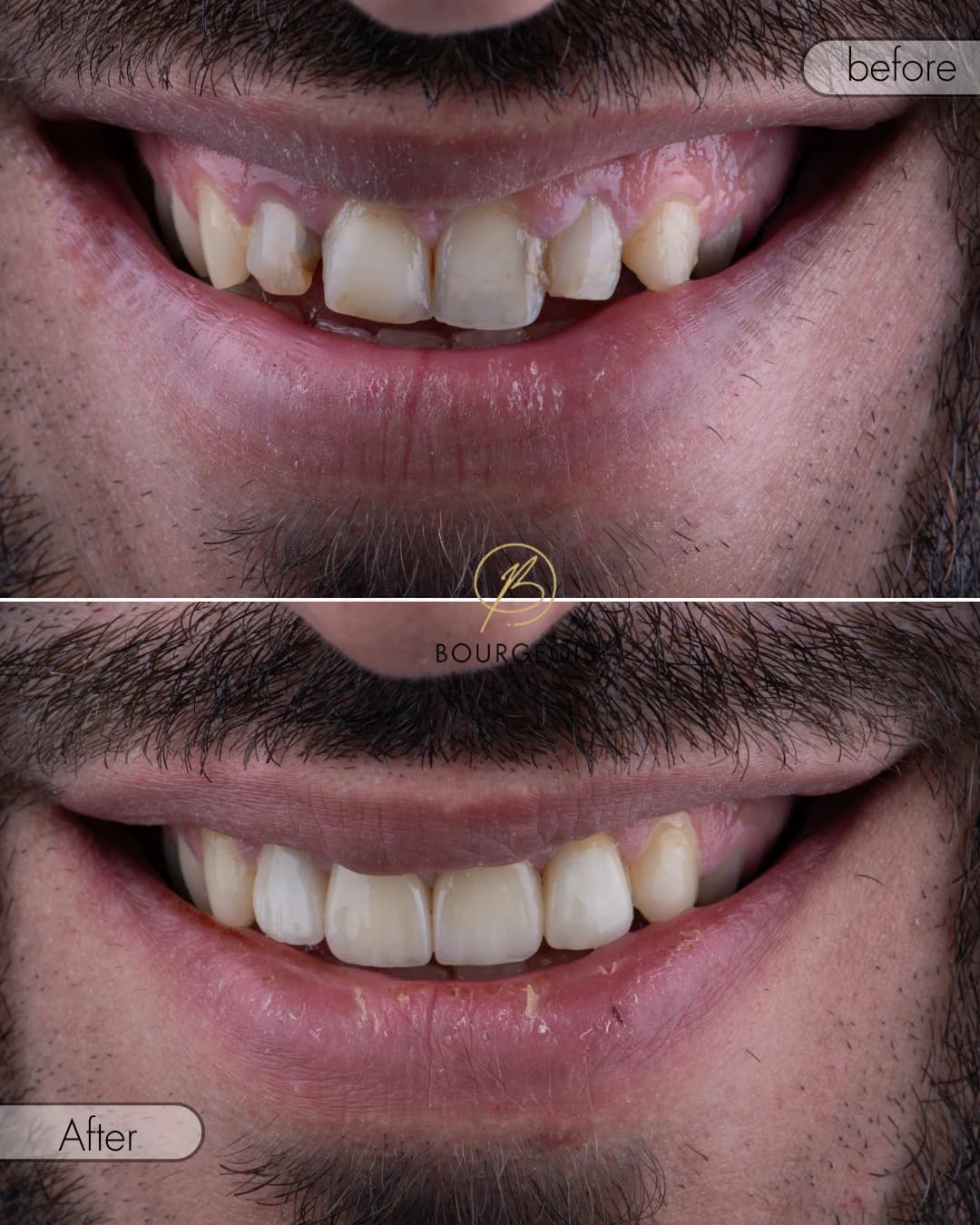 Bourgeois Dental Clinic - Case 9 | Bourgeois Dental Clinic