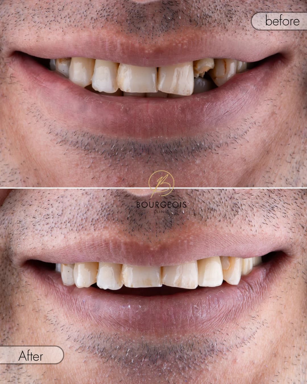 Bourgeois Dental Clinic - Case 5 | Bourgeois Dental Clinic