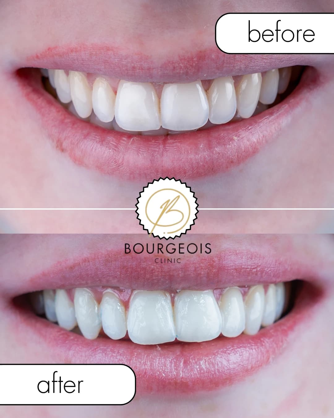 Bourgeois Dental Clinic - Case 4 | Bourgeois Dental Clinic