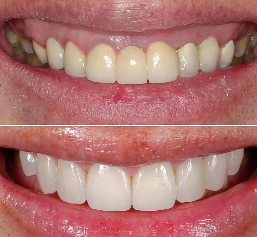 Bourgeois Dental Clinic - Case 4 | Bourgeois Dental Clinic