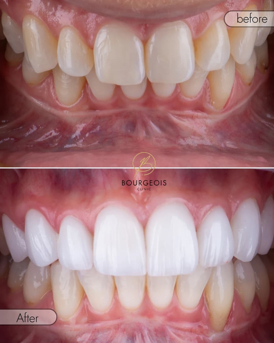 Bourgeois Dental Clinic - Case 2 | Bourgeois Dental Clinic