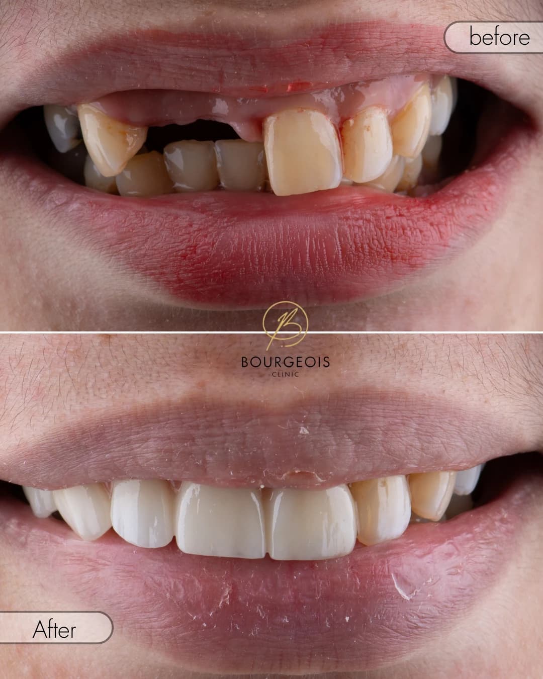 Bourgeois Dental Clinic - Case 3 | Bourgeois Dental Clinic