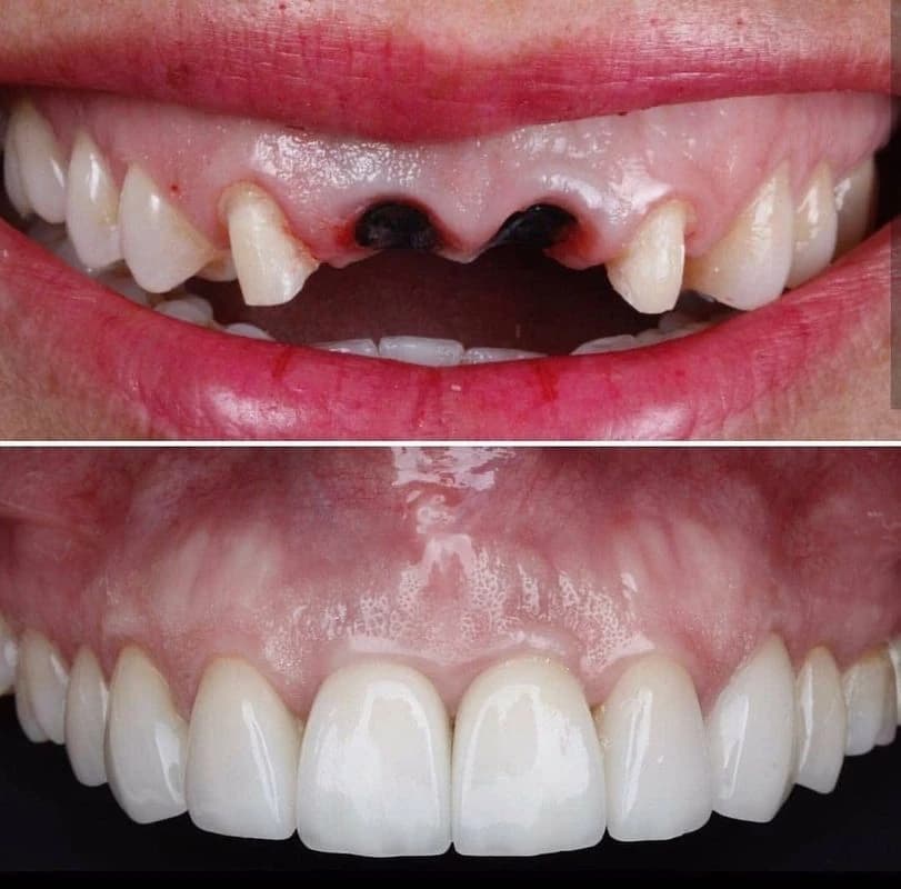 Bourgeois Dental Clinic - Case 2 | Bourgeois Dental Clinic