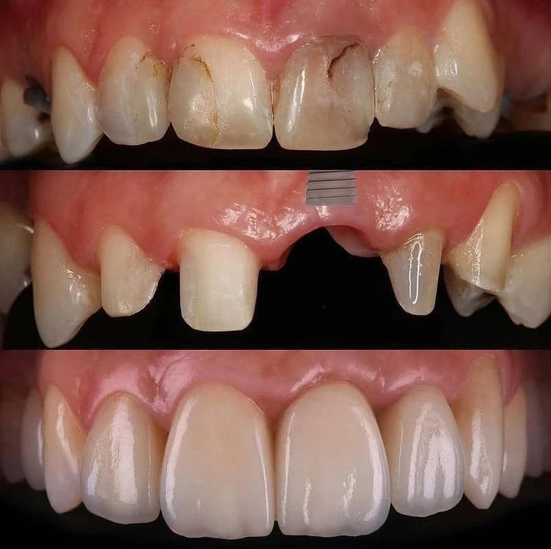 Bourgeois Dental Clinic - Case 3 | Bourgeois Dental Clinic