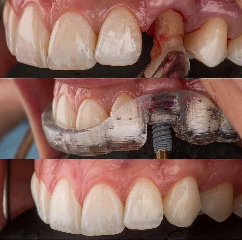 Bourgeois Dental Clinic - Case 4 | Bourgeois Dental Clinic