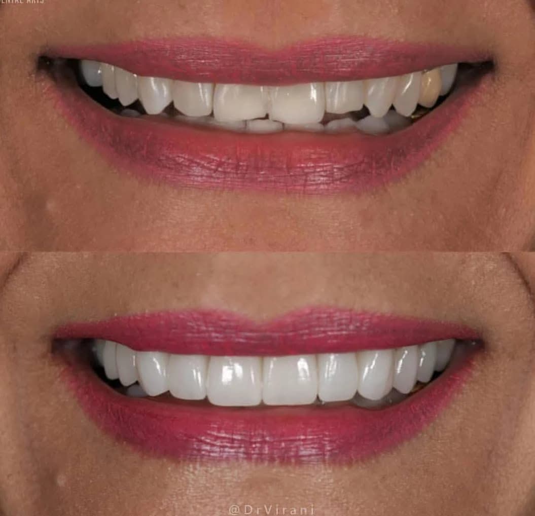 Bourgeois Dental Clinic - Case 5 | Bourgeois Dental Clinic