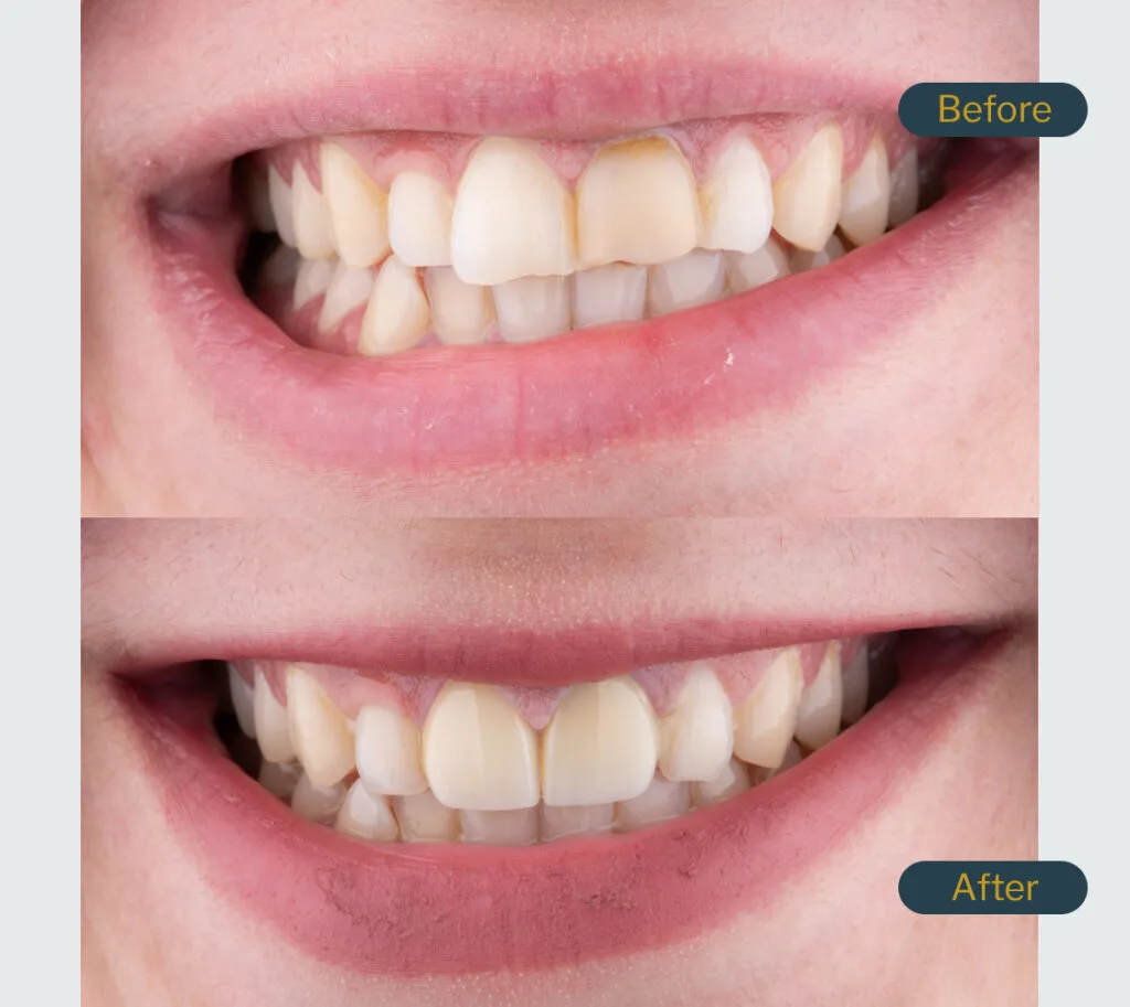 Bourgeois Dental Clinic - Case 1 | Bourgeois Dental Clinic
